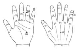 임상사례(1)-습관성유산