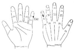 학술위원 지상강좌(51)-티눈