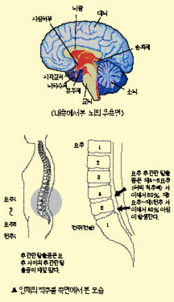 최신 온열요법(15)'서암뜸'파킨슨-요통 예방