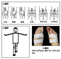 서금요법 이용 골반교정법(2)