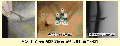 최신 온열요법(22)-복부에 뜸 뜰 수록 복냉증 심해진다