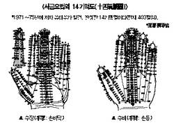최신 온열요법(26)-서금요법 온열자극 가장 과학적