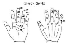 최신 온열요법(30)-응급시 순금침봉 자극 정신 회복