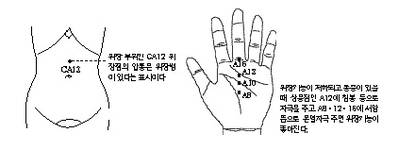 최신온열요법(33)-위장 CA12자극 압통있으면 위장병