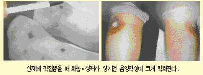 최신온열요법(35)-손 제외한 신체 뜸 음양맥상 악화