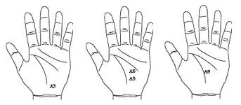최신온열요법(52)-'A3'에 서암뜸 뜨면 방광기능 강화
