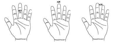 최신온열요법(54)-'A30'에 서암뜸뜨면 치매 예방 완화