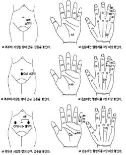 최신온열요법(73)-소장기능을 조절하는 치방