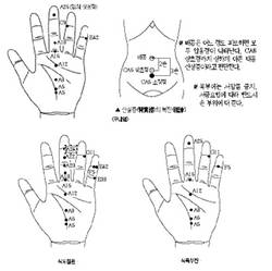 최신온열(76)-질환별 서암뜸 치방