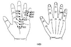 최신온열(78)-'토혈' 반드시 손에 장기간 서암뜸 떠야