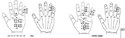 최신온열(80)-대장기맥에 서암뜸 뜨면 장중첩 증상 해소