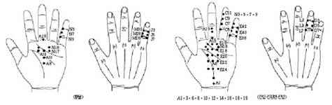 최신온열(81)-서암뜸으로 간질환에 큰 도움