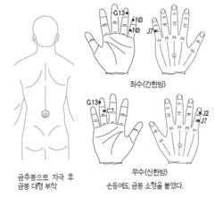 임상사례-금봉 부착 퇴행성 요통 해소
