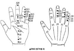최신온열(84)-'서암뜸'순환기계 질환에 큰 도움줘