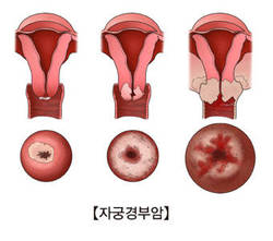 완치율 높은 ‘착은 암’…백신 접종으로 95% 예방