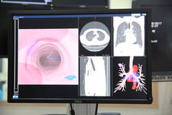 부산대병원, 국내 최초 「가상 기관지내시경 네비게이션」 도입