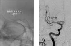 해운대백병원, 뇌경색 신 치료법으로 안전도 높여