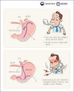 가슴 안쪽 타는 듯한 통증이나 쓰림 주증상