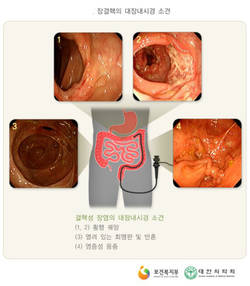 폐 아닌 소장·대장에 결핵균 침범…20~50대 다발