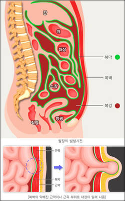 약해진 복벽 탓에 복강 내 내장 밀려나와 돌출