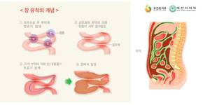 복통·구토·설사 주증상… '대장암 신호'일 수도