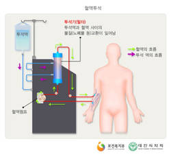 신장 기능 10~15%에도 약물·식이요법 치료 가능