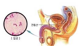 재발잦고 전염성 강해 남녀 동시 검사·치료 받아야