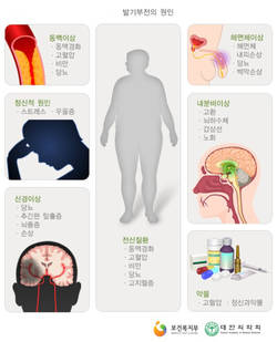 당뇨·고혈압·흡연도 ‘고개숙인 남성’ 만든다