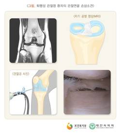 노화로 인한 관절 연골 손상…손가락·무릎 통증 호소