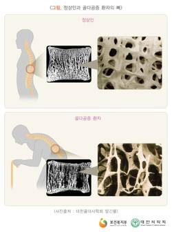 50세 이상 女 22.4% 뼈에 구멍 '숭숭'…男환자 1/5