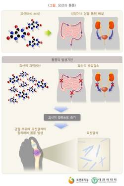 혈액 내 요산 농도 증가…발가락 붓고 심한 통증 유발