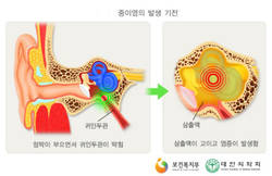 생후 6개월~2세 전후 다발…방치하면 청력 손상