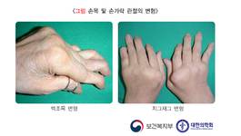 아침마다 관절 굳고 뻣뻣… 대표적 자가면역질환