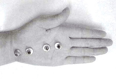 주름이 심한 손의 시술