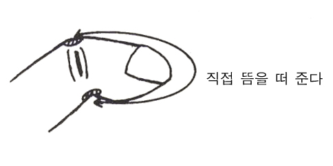 환부에 직접 뜸을 떠 호전된 경우