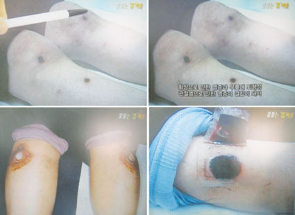 지난달 29일 kbs1 취재파일에서 '불붙는 뜸싸움'이라는 제목으로 신체에 직접뜸을 떠 생긴 부작용을 방영했다.