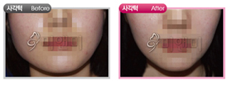 미앤미 이병훈 원장의 '사각턱' 시술 전, 후 모습.