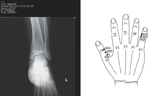사고 당시 손상된 성장판 사진
