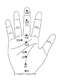 갑상선 기능항진증