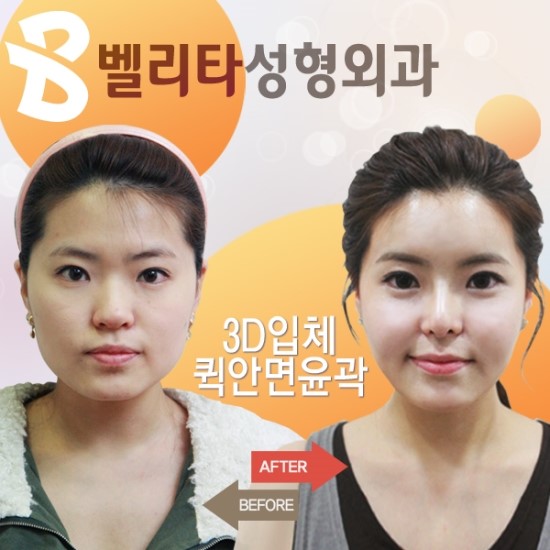 2011.7.1.부터 미용목적 성형수술 등이 과세로 전환됨에 따라 다음 용역을 제공한 성형외과 등은 부가세를 신고납부 해야한다.<쌍거풀수술, 코성형수술, 유방확대․축소술, 지방흡인술, 주름살제거술 등. 사진은 본 기사와 전혀 관련이 없음.>