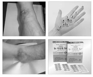 2차 자극(사진위)와 4차 자극 후 모습