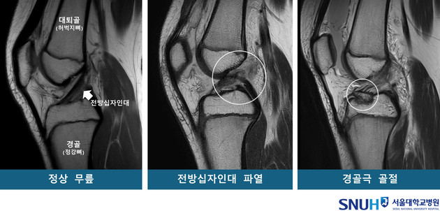 소아청소년 무릎, 타고난 모양에 따라 부상 양상 달라