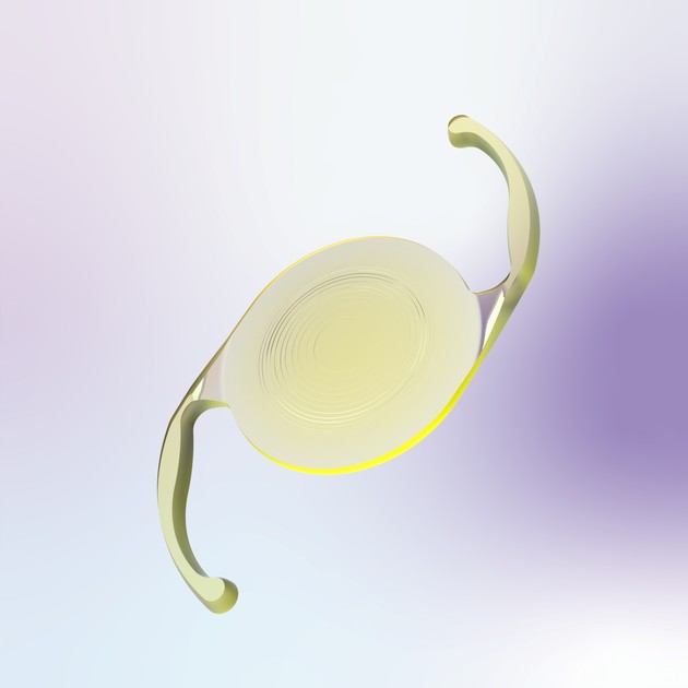 알콘, 삼중초점 인공수정체 '팬옵틱스' 글로벌 삽입 300만례 돌파