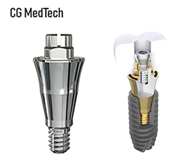시지메드텍, 치과 임플란트 보철 '우루덴트 SA' 출시