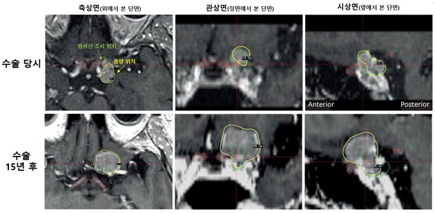 시신경 인접 수막종, 방사선 줄이면 10년 뒤 시력 저하 위험