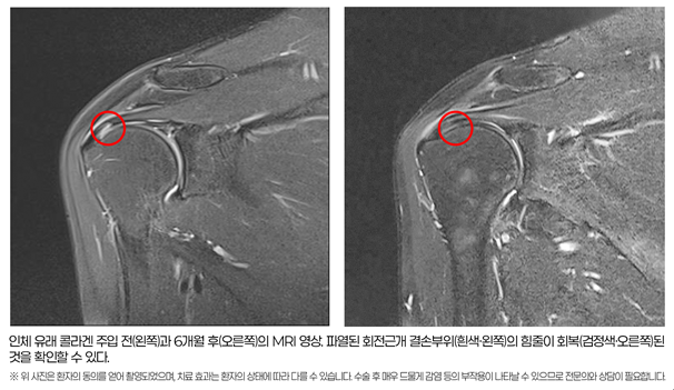 힘찬병원, 회전근개 부분 파열 '콜라겐 주입' 치료 효과 확인