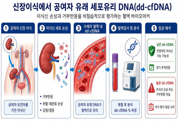 신장이식 후 불필요한 조직검사 줄인다…혈액검사 결합해 '거부반응 정밀 선별'