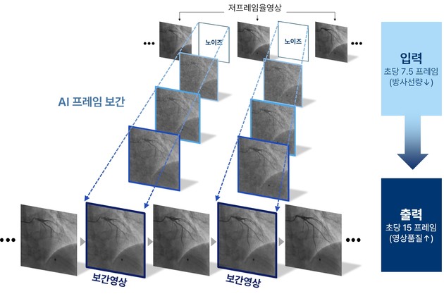 방사선량 절반 줄인 관상동맥조영술… 분당서울대병원, AI 보간 모델 개발