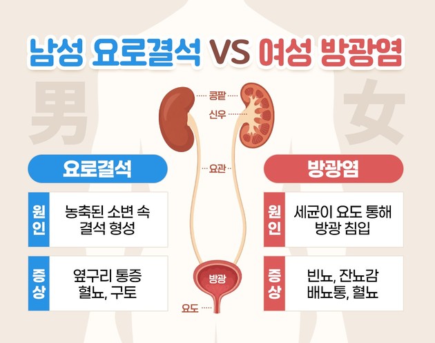 폭염·휴가철 '요로 비상'…남성은 결석, 여성은 방광염 주의
