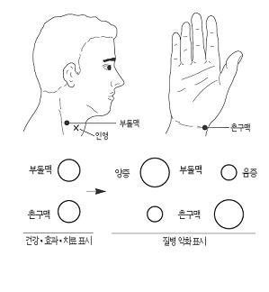 합곡혈에 침‧뜸 교감신경 항진